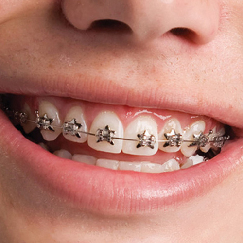 Star brackets Greece Orthodontics & Pediatric Dentistry